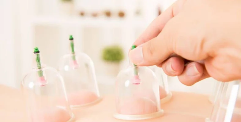 حجامة لعلاج آلام المفاصل